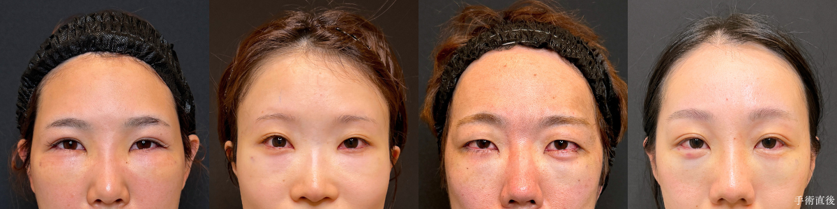 裏ハムラ法 手術直後の4名の目元