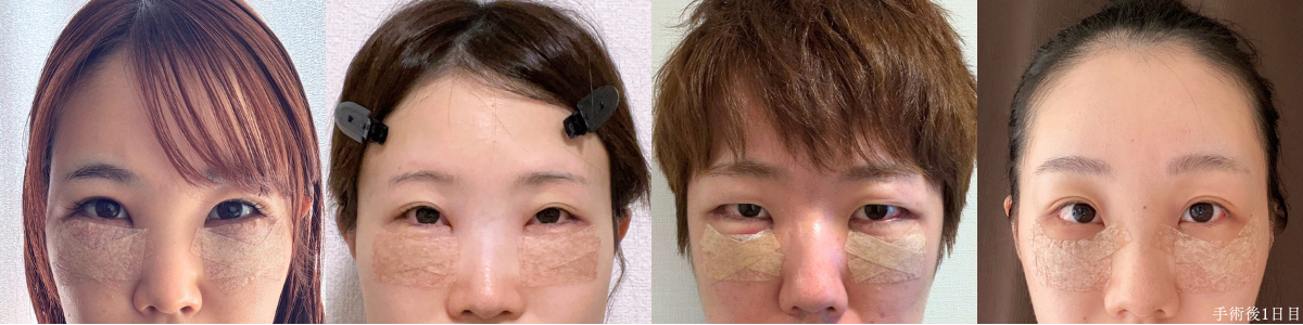裏ハムラ法 術後1日目の4名の目元（テープ固定中の腫れ）