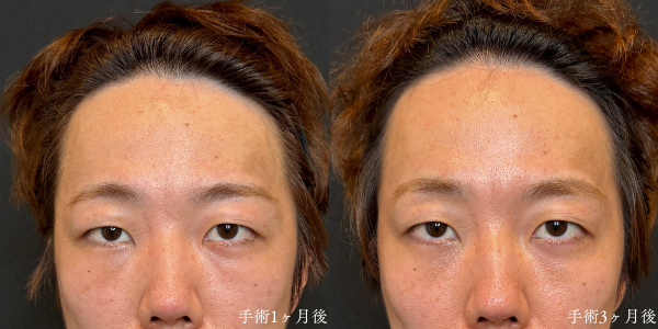裏ハムラ法 術後1か月と3か月の比較（目の下の腫れ感が落ち着いていく経過）