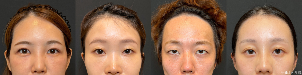 裏ハムラ法 手術3か月後の4名の目元（腫れが落ち着いた状態）