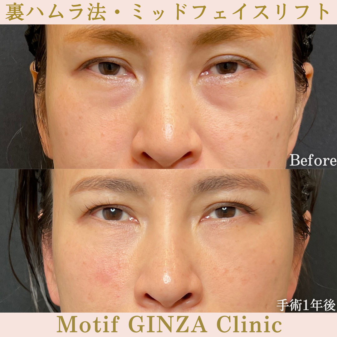 裏ハムラ法・ミッドフェイスリフト（手術１年）の写真