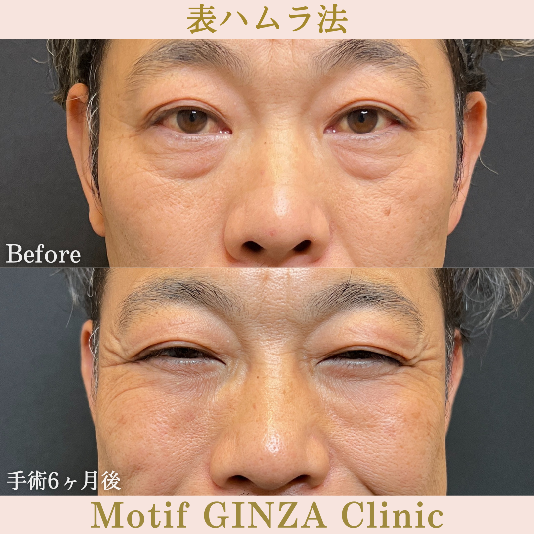 切開式下眼瞼たるみ取り(手術6ヶ月)の写真2