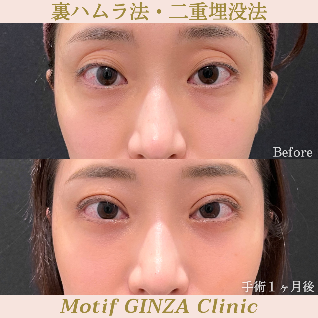 裏ハムラ法・二重埋没法（手術３ヶ月）の写真3