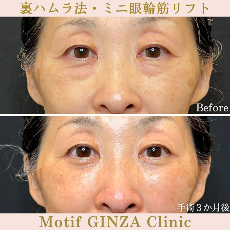 裏ハムラ法・ミニ眼輪筋リフト（手術3か月）