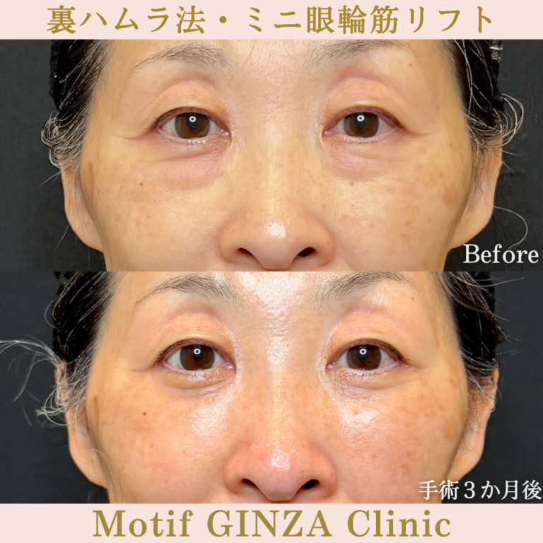 裏ハムラ法・ミニ眼輪筋リフト（手術6か月）の写真3