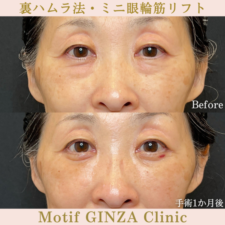 裏ハムラ法・ミニ眼輪筋リフト（手術6か月）の写真5
