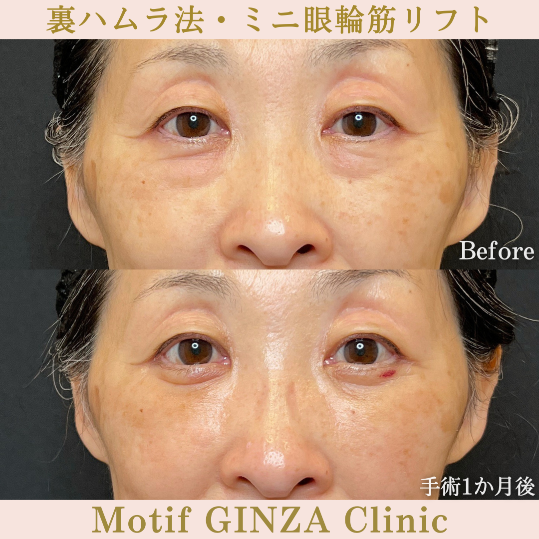 裏ハムラ法・ミニ眼輪筋リフト(手術6か月)の写真5