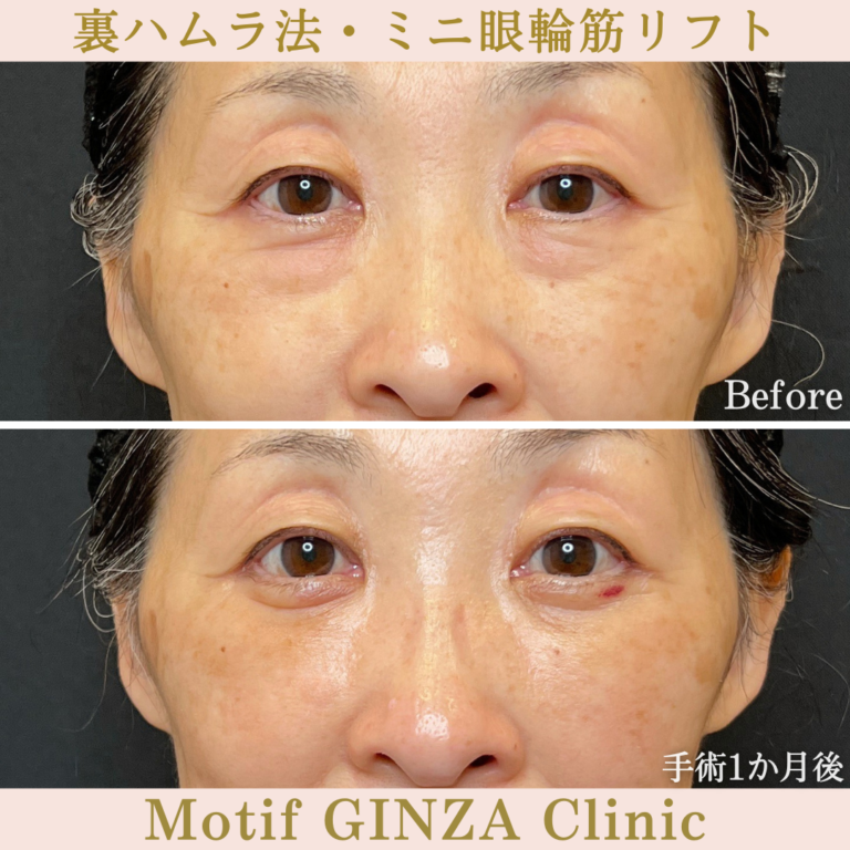 裏ハムラ法・ミニ眼輪筋リフト（手術1か月）