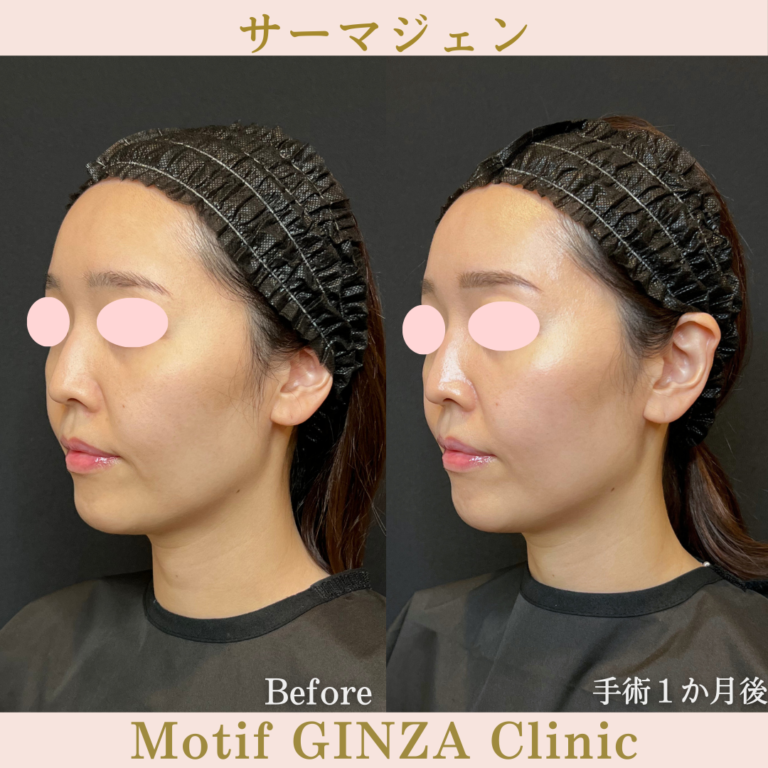 サーマジェン(手術1か月)の写真2