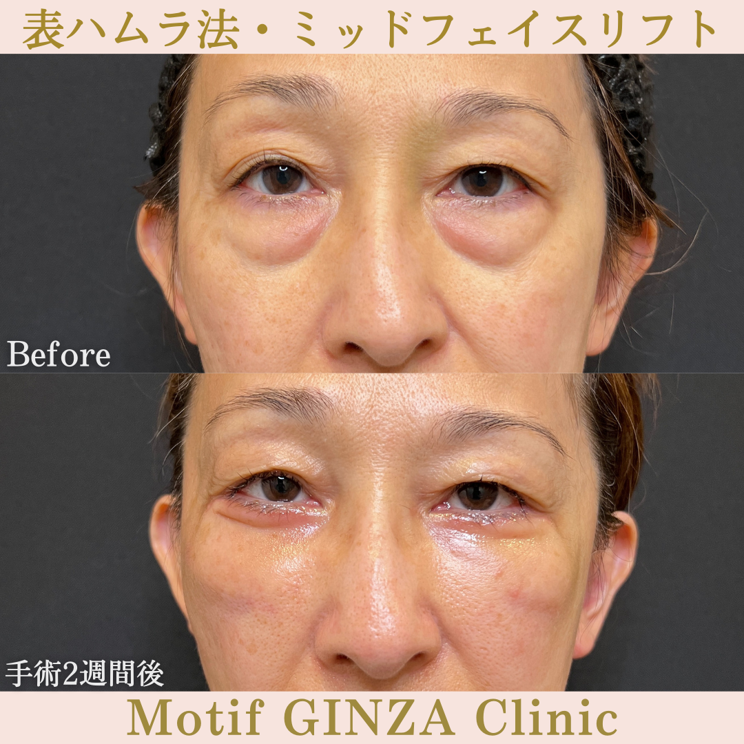 切開式下眼瞼たるみ取り・ミッドフェイスリフト(手術3ヶ月)の写真3
