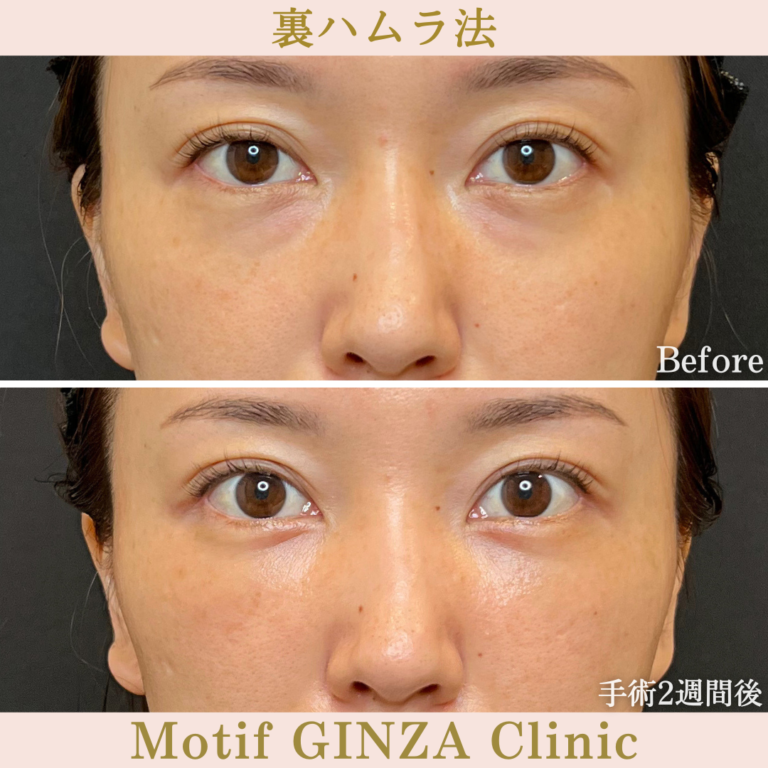 裏ハムラ法（手術3か月）の写真5