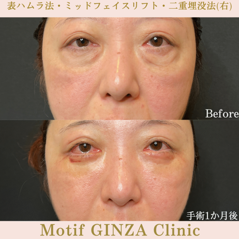 切開式下眼瞼たるみ取り・ミッドフェイスリフト・二重埋没法（手術６か月）の写真5