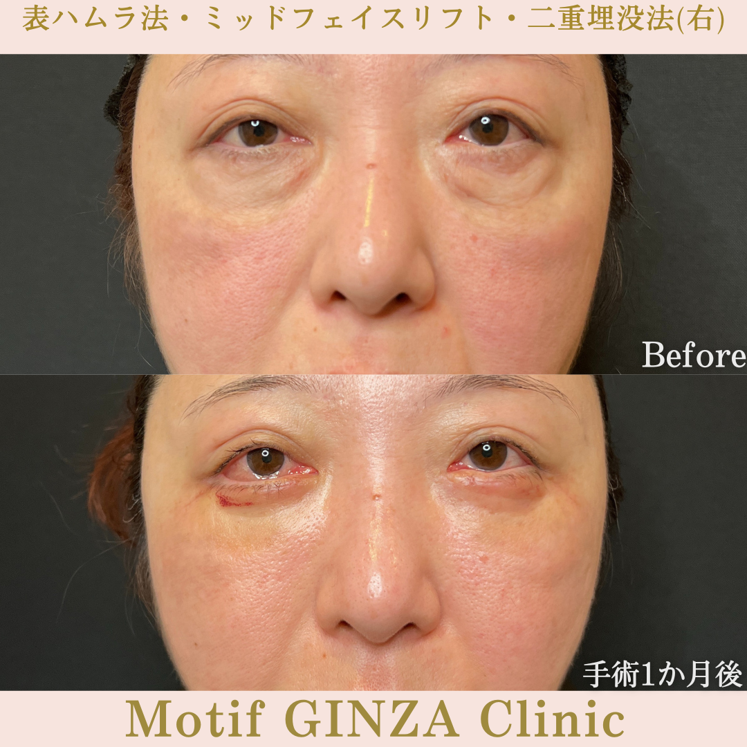 切開式下眼瞼たるみ取り・ミッドフェイスリフト・二重埋没法（手術６か月）の写真5