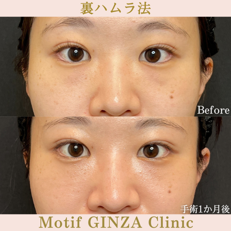 裏ハムラ法（手術１か月）