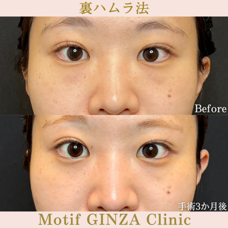 裏ハムラ法（手術3か月）