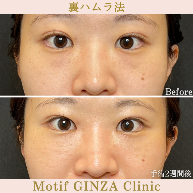 裏ハムラ法（手術2週間）