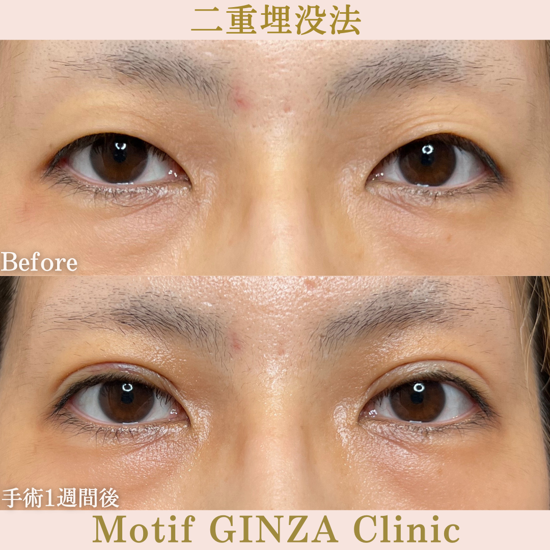 二重埋没法（手術１か月）の写真2