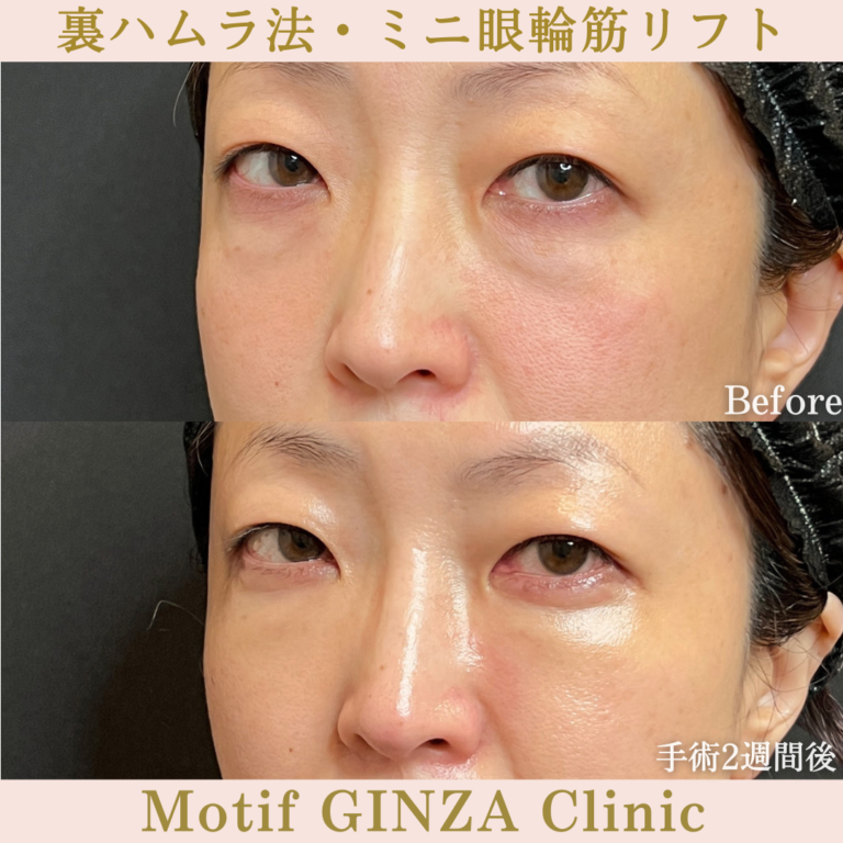 裏ハムラ法・ミニ眼輪筋リフト(手術1か月)の写真4