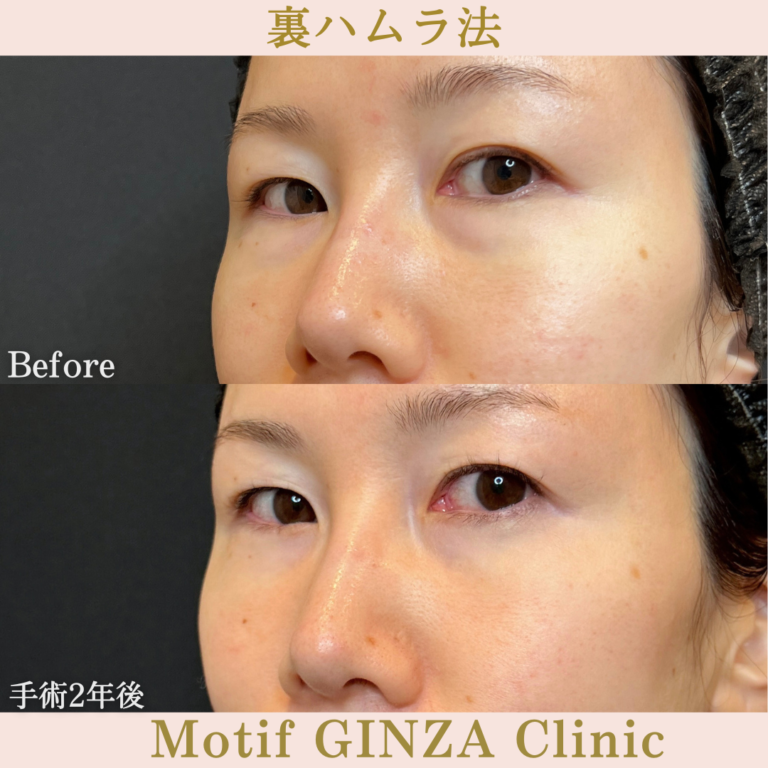 裏ハムラ法（手術2年）の写真2