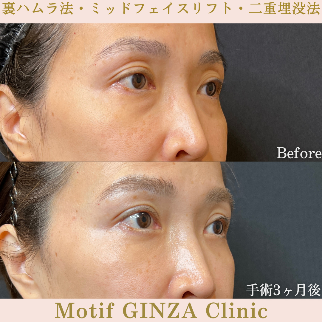 裏ハムラ法・ミッドフェイスリフト・二重埋没法（手術６ヶ月）の写真5