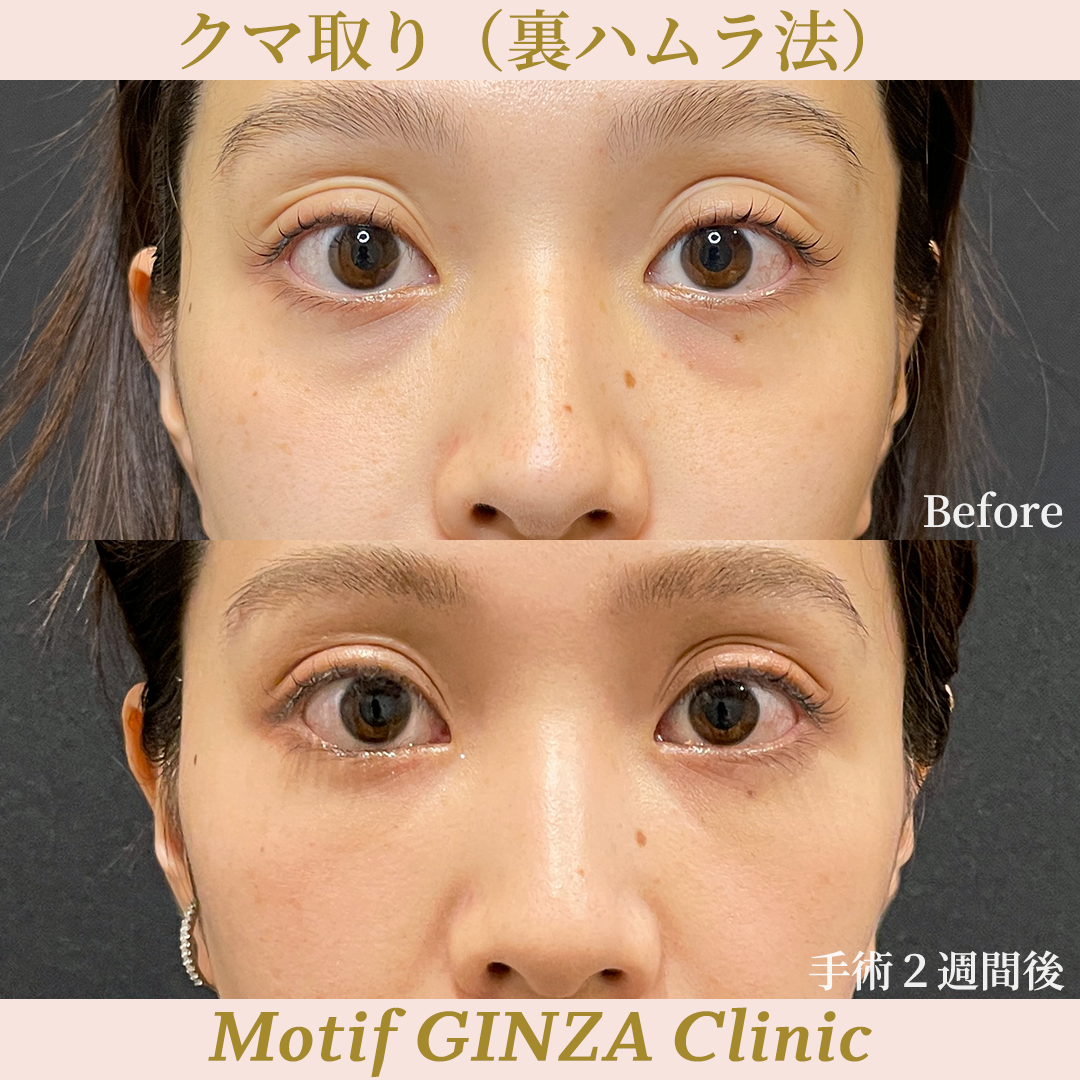 裏ハムラ法（手術３ヶ月）の写真3