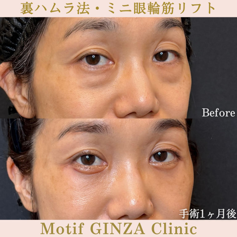 裏ハムラ法・ミニ眼輪筋リフト（手術３か月）の写真4