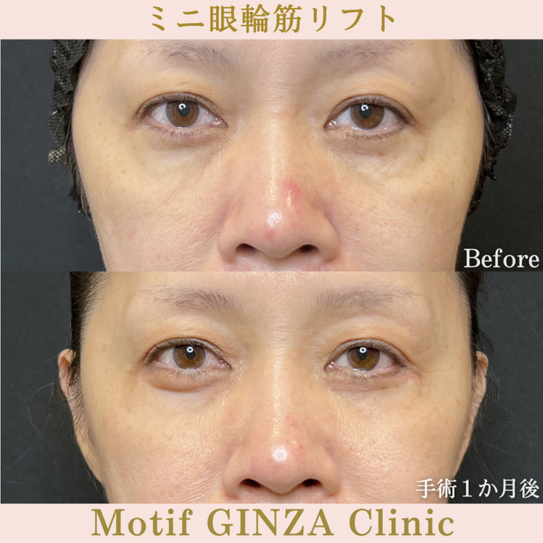 ミニ眼輪筋リフト（手術３か月）の写真3