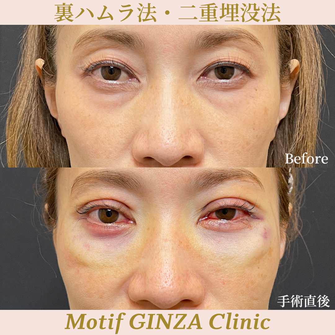 裏ハムラ法・二重埋没法（手術３ヶ月）の写真6