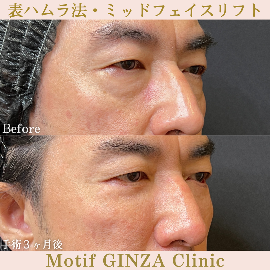 切開式下眼瞼たるみ取り・ミッドフェイスリフト(手術6ヶ月)の写真4