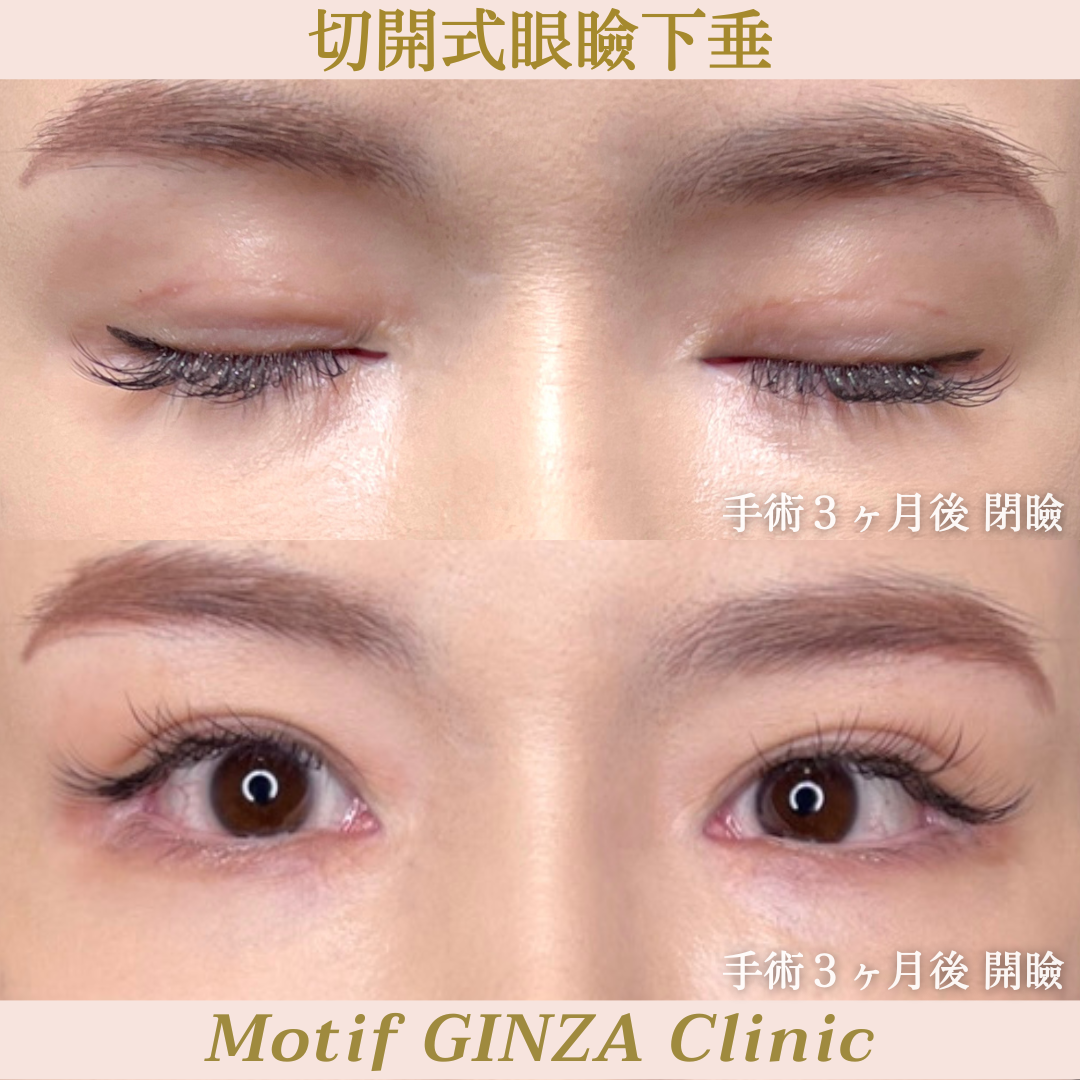 切開式眼瞼下垂手術(手術3ヶ月)の写真2