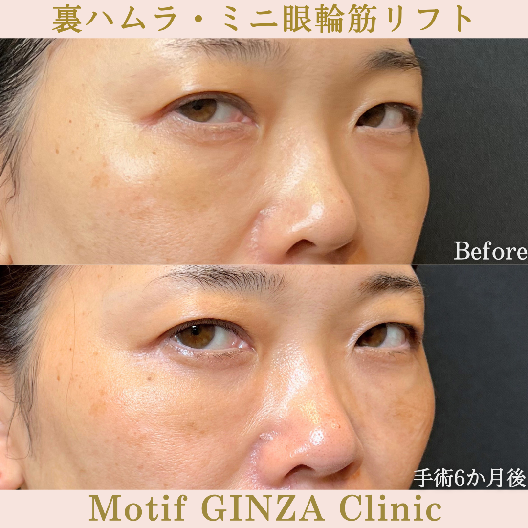 裏ハムラ法・ミニ眼輪筋リフト(手術10か月)の写真4