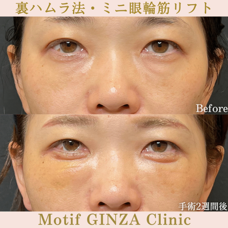 裏ハムラ法・ミニ眼輪筋リフト（手術１か月）の写真3