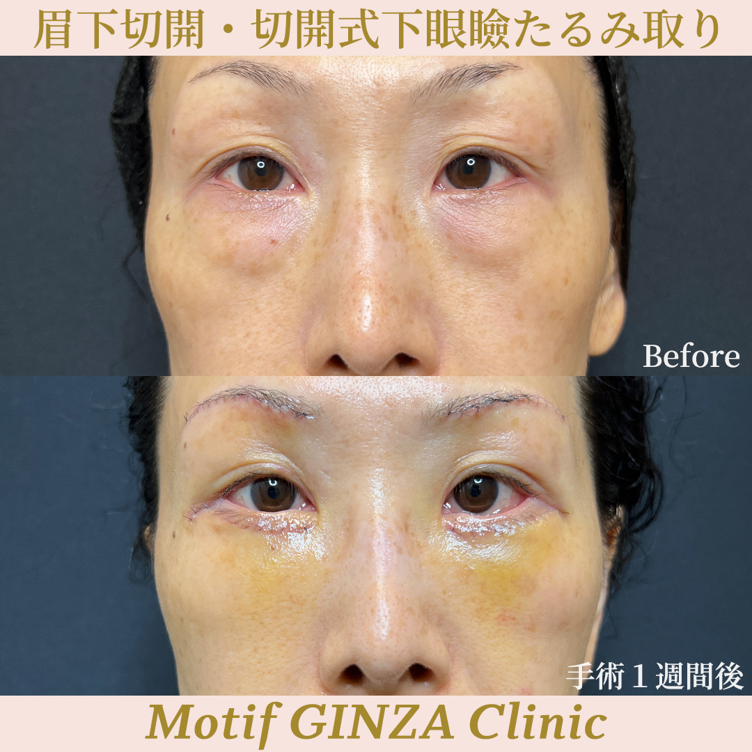 眉下切開・切開式下眼瞼たるみ取り(手術3ヶ月)の写真5