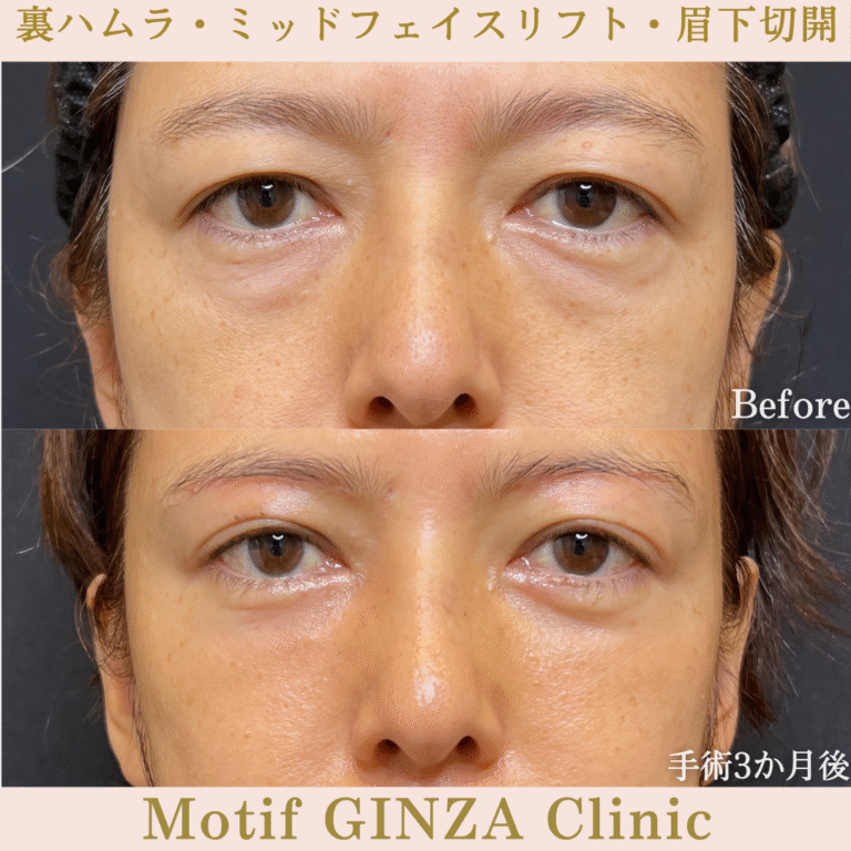 裏ハムラ法・ミッドフェイスリフト・眉下切開（手術６か月）の写真3