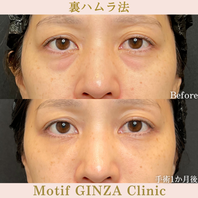 裏ハムラ法（手術1か月）