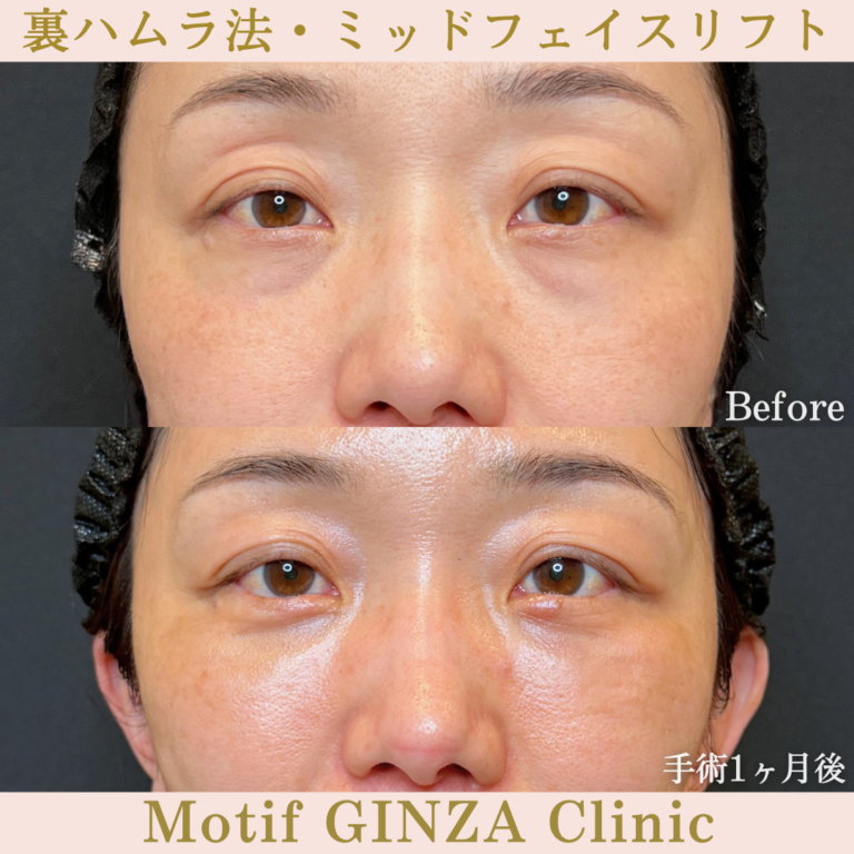 裏ハムラ法・ミッドフェイスリフト(手術3か月)の写真3