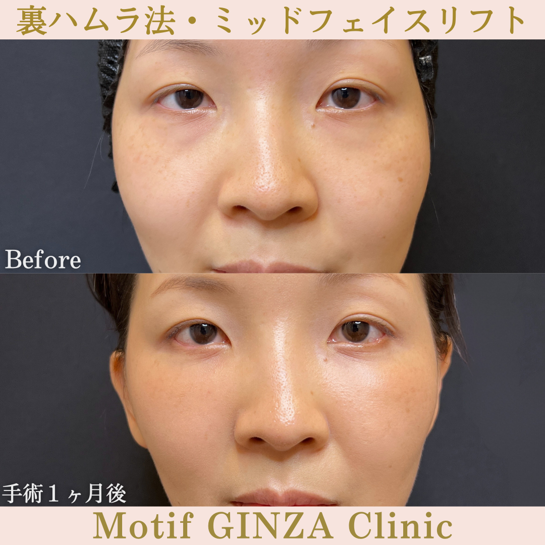 裏ハムラ法・ミッドフェイスリフト（手術３ヶ月）の写真3