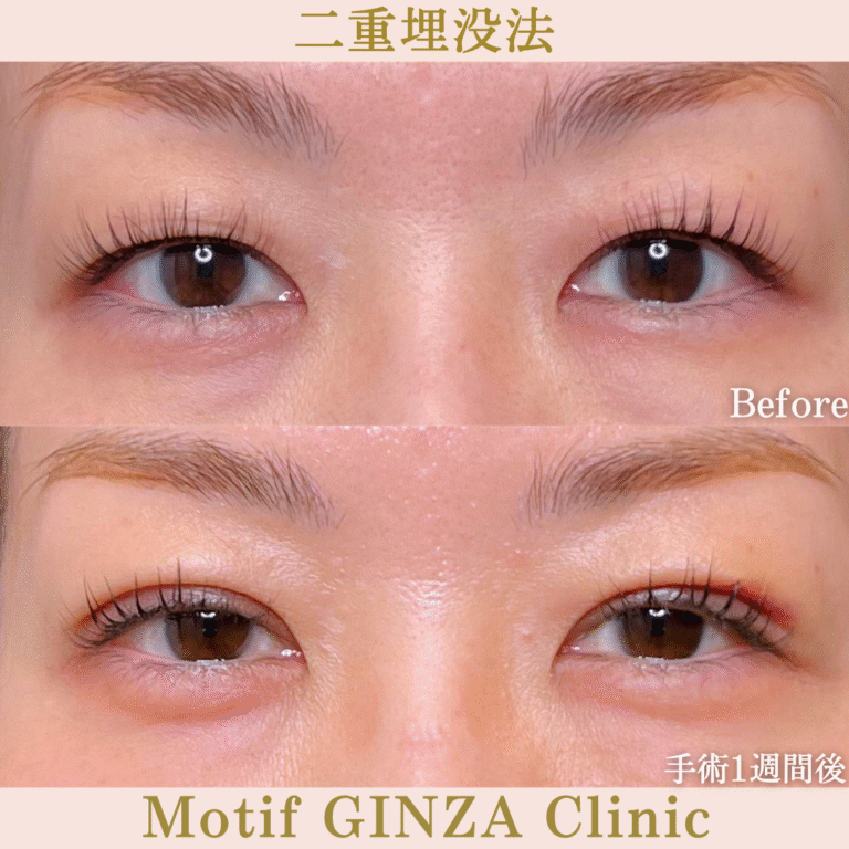 二重埋没法(手術1か月)の写真2