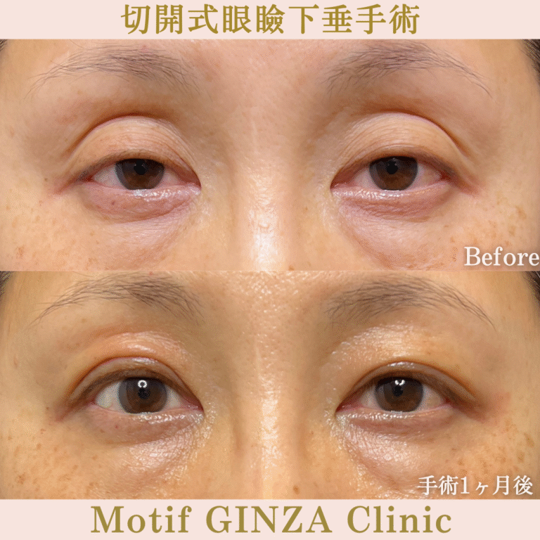 切開式眼瞼下垂手術（手術６ヶ月）の写真4