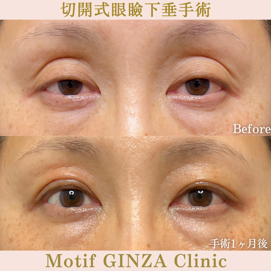 切開式眼瞼下垂手術（手術６ヶ月）の写真4