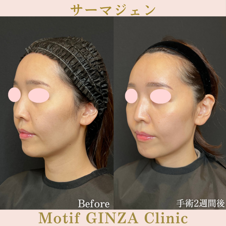 サーマジェン(手術1か月)の写真4