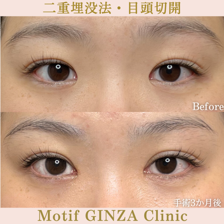 二重切開法・目頭切開（手術6か月）の写真3