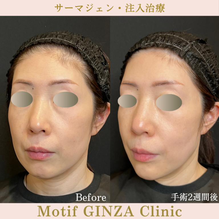 サーマジェン・注入治療(手術1か月)の写真4