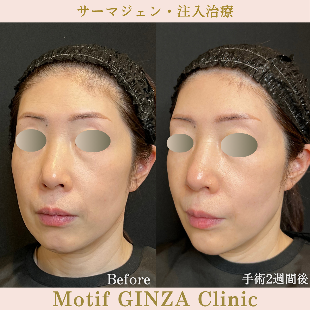 サーマジェン・注入治療(手術1か月)の写真4