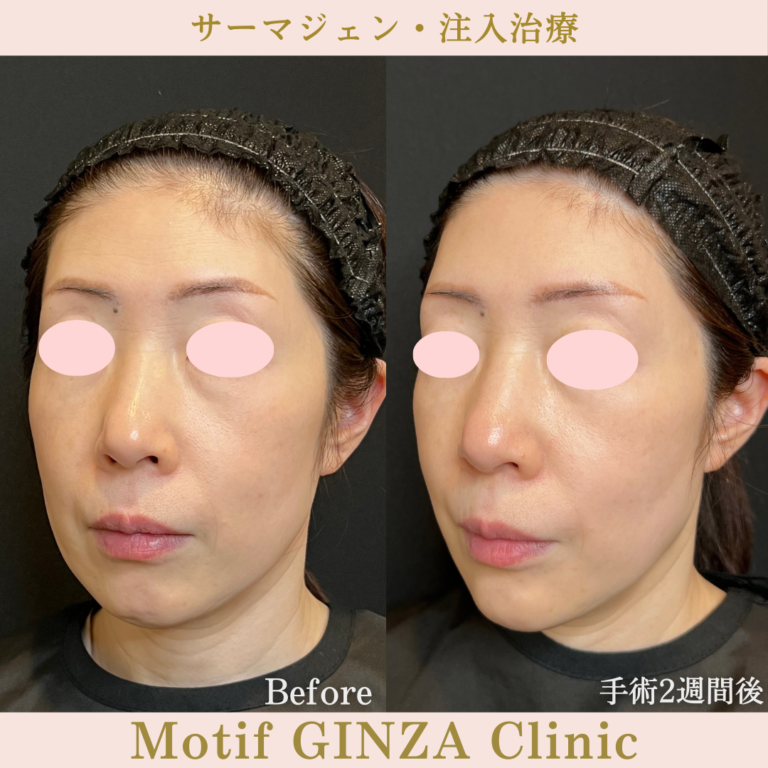 サーマジェン・注入治療（手術1か月）の写真4