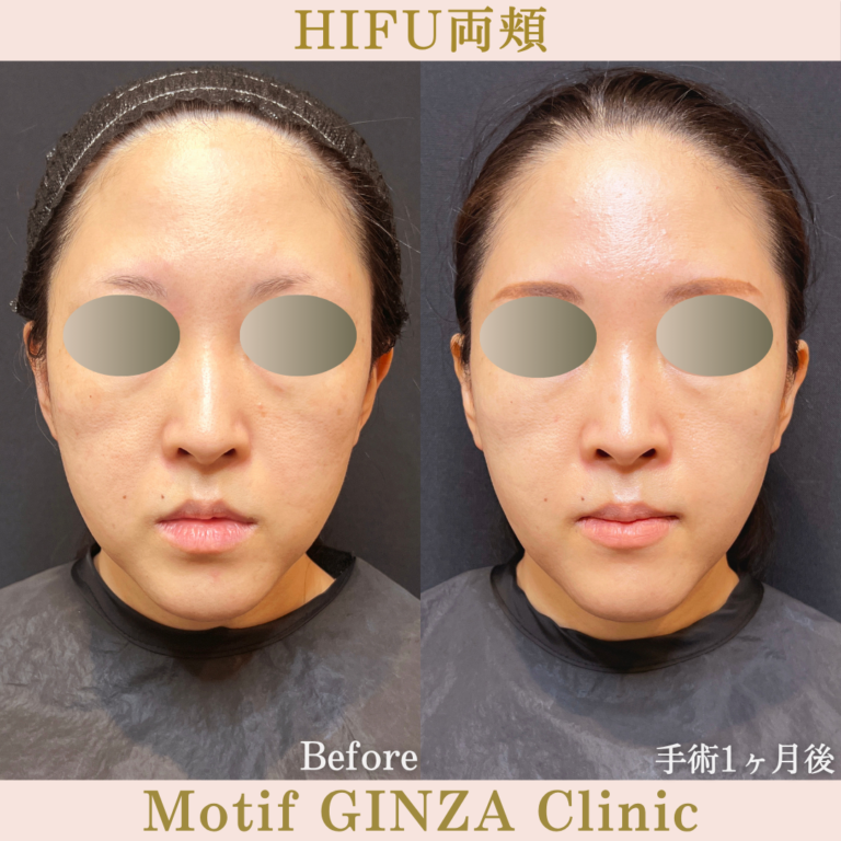 HIFU両頬（手術１ヶ月）