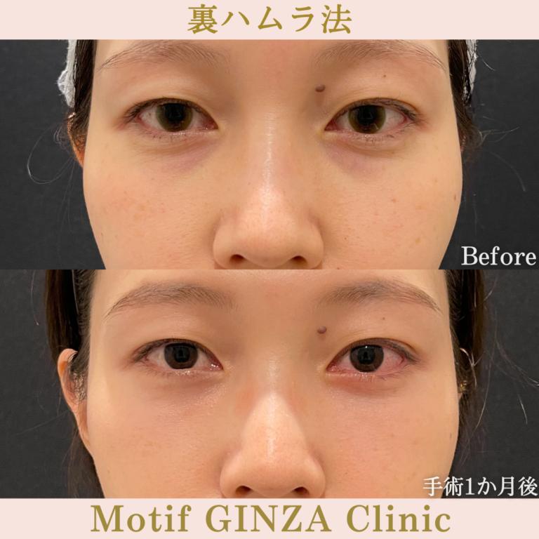 裏ハムラ法（手術３ヶ月）の写真3