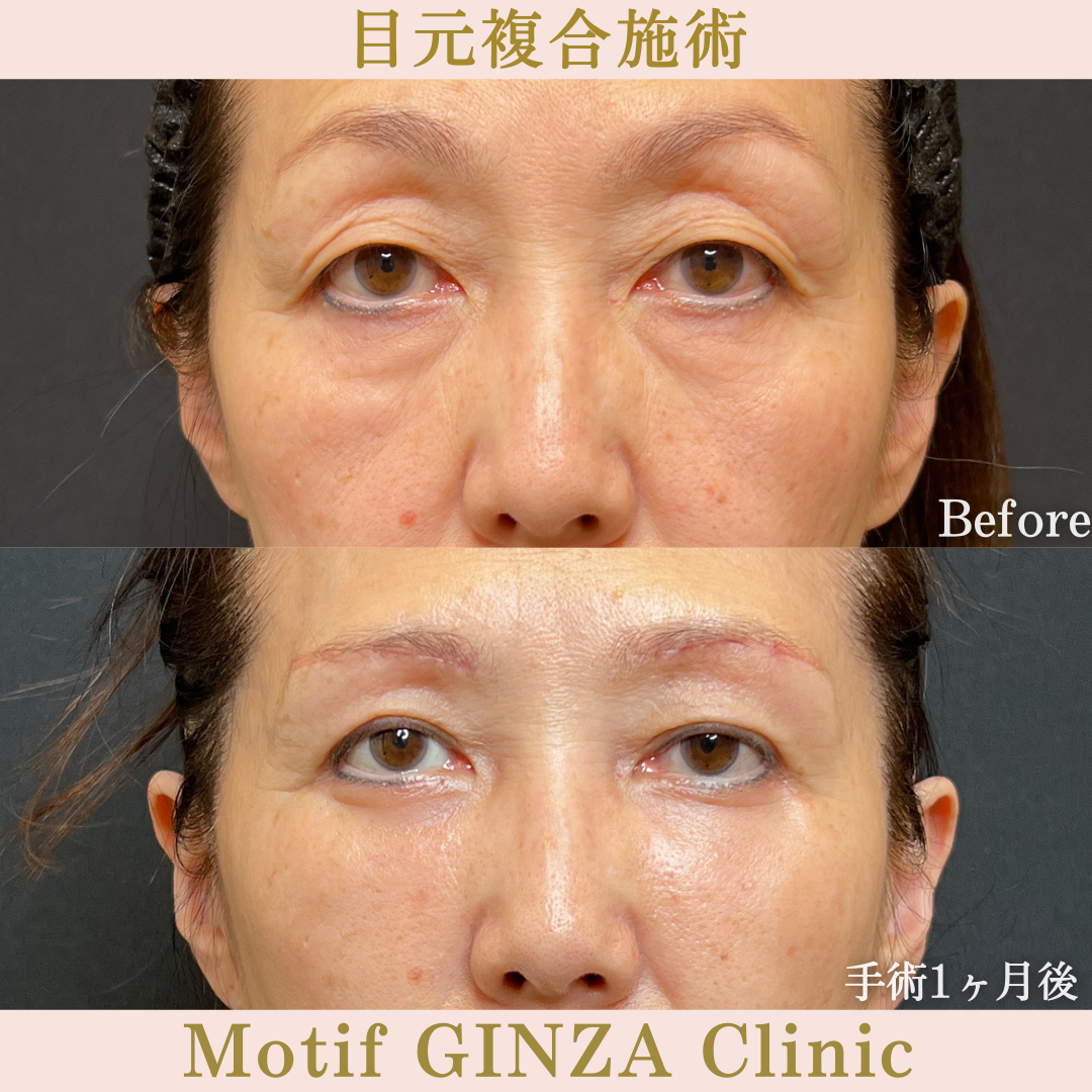 目元複合手術(手術6ヶ月)の写真5