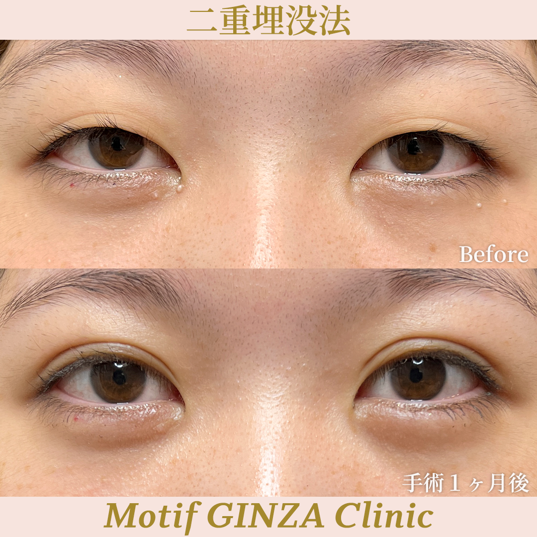 二重埋没法（手術１ヶ月）の写真