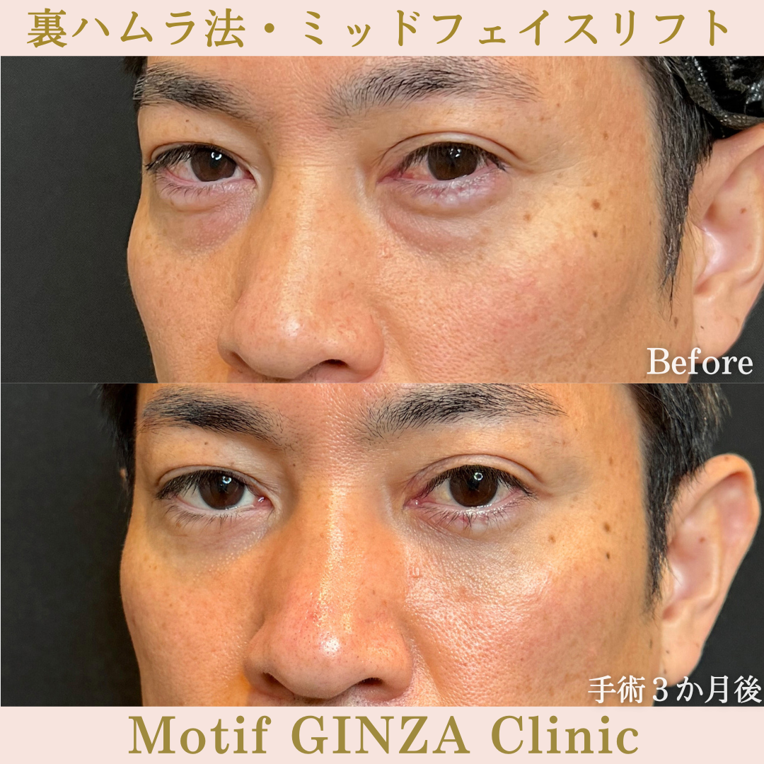 裏ハムラ法・ミッドフェイスリフト(手術6か月)の写真4